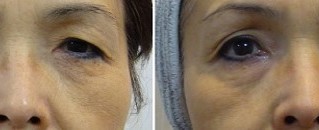 目元のたるみ、眼瞼下垂を改善するレーザー治療