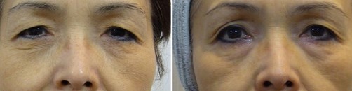 目元のたるみ、眼瞼下垂を改善するレーザー治療